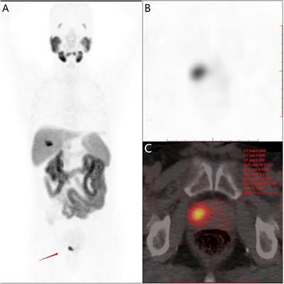 18F-PSMA-1007 PET/CT-derived semi-quantitative parameters for risk stratification of newly diagnosed prostate cancer